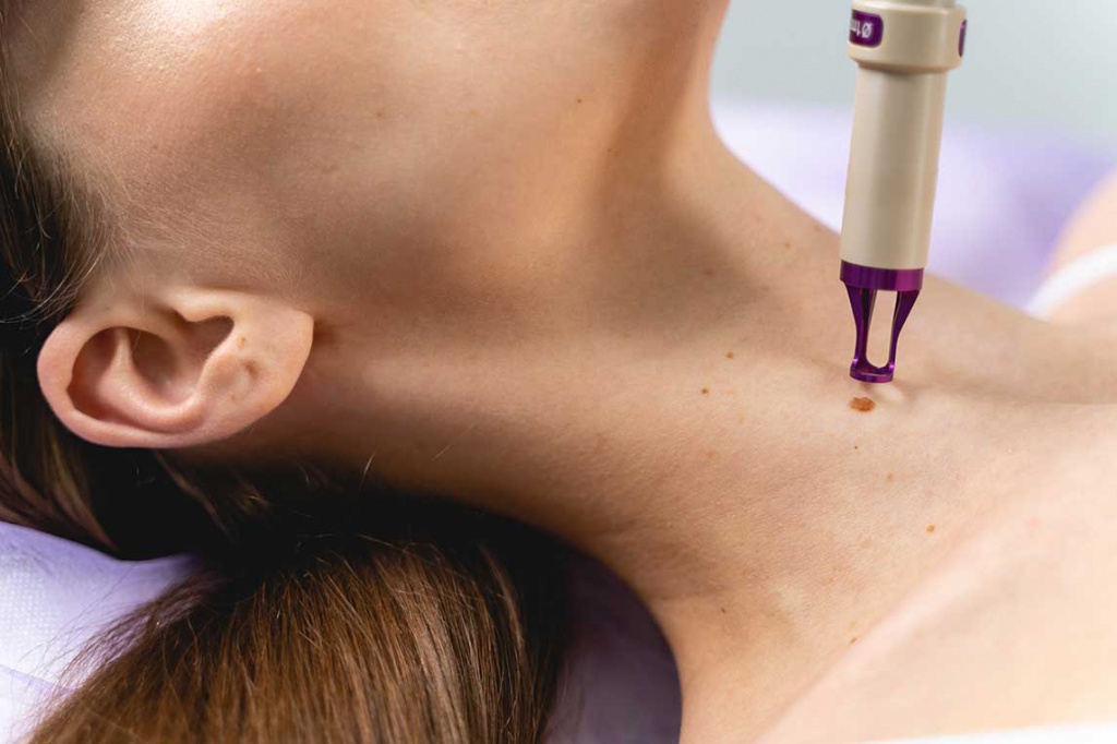 Девушке удаляют невус лазером