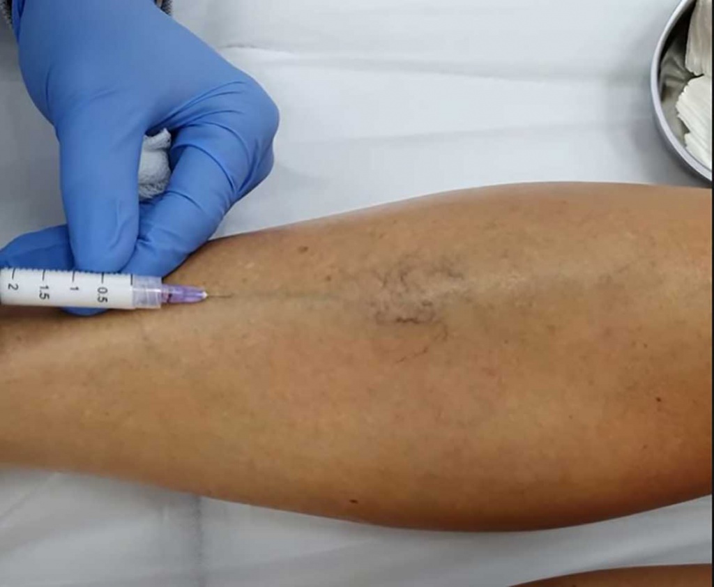 Врач проводит склеротерапию вен