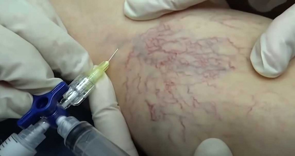 Доктора проводят процедуру склеротерапии вен