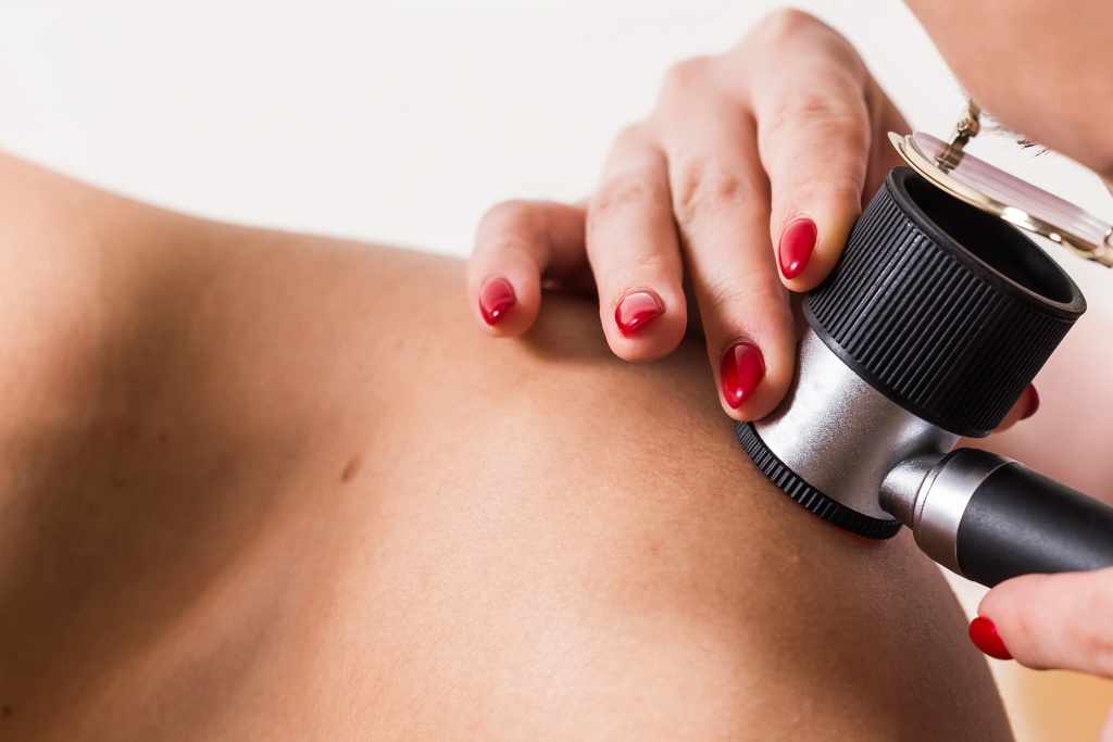 удаление родинок лазером