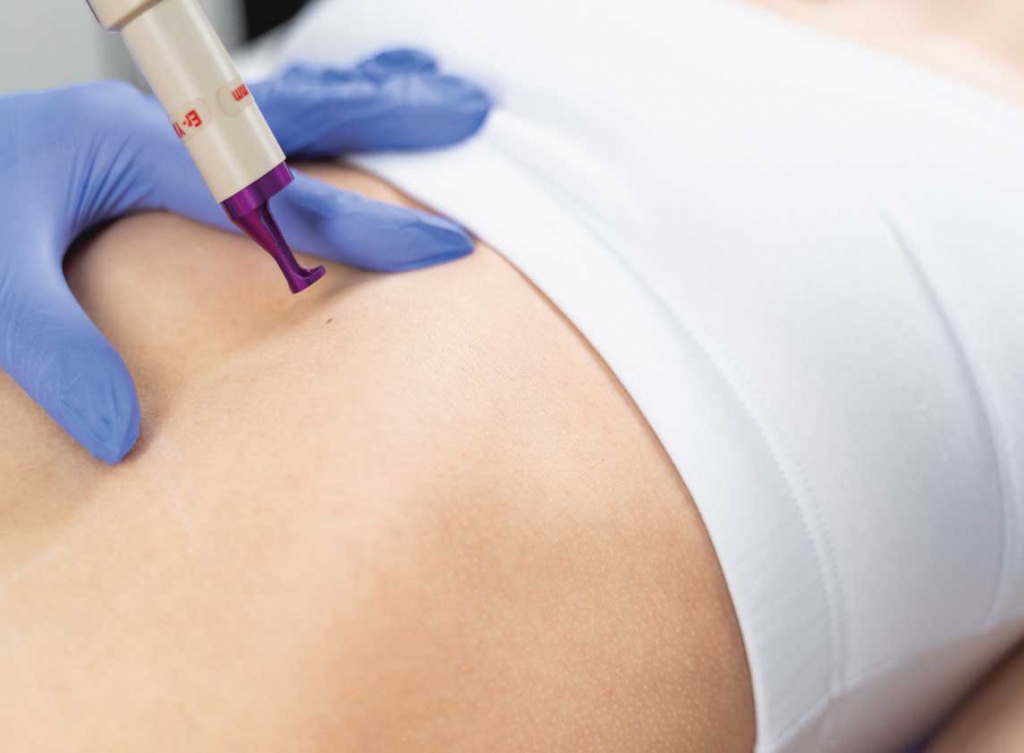 удаление папиллом лазером