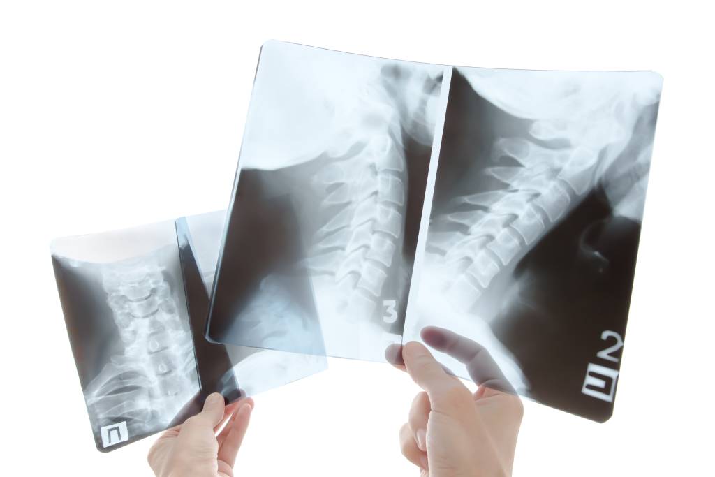 протрузия шейного отдела позвоночника