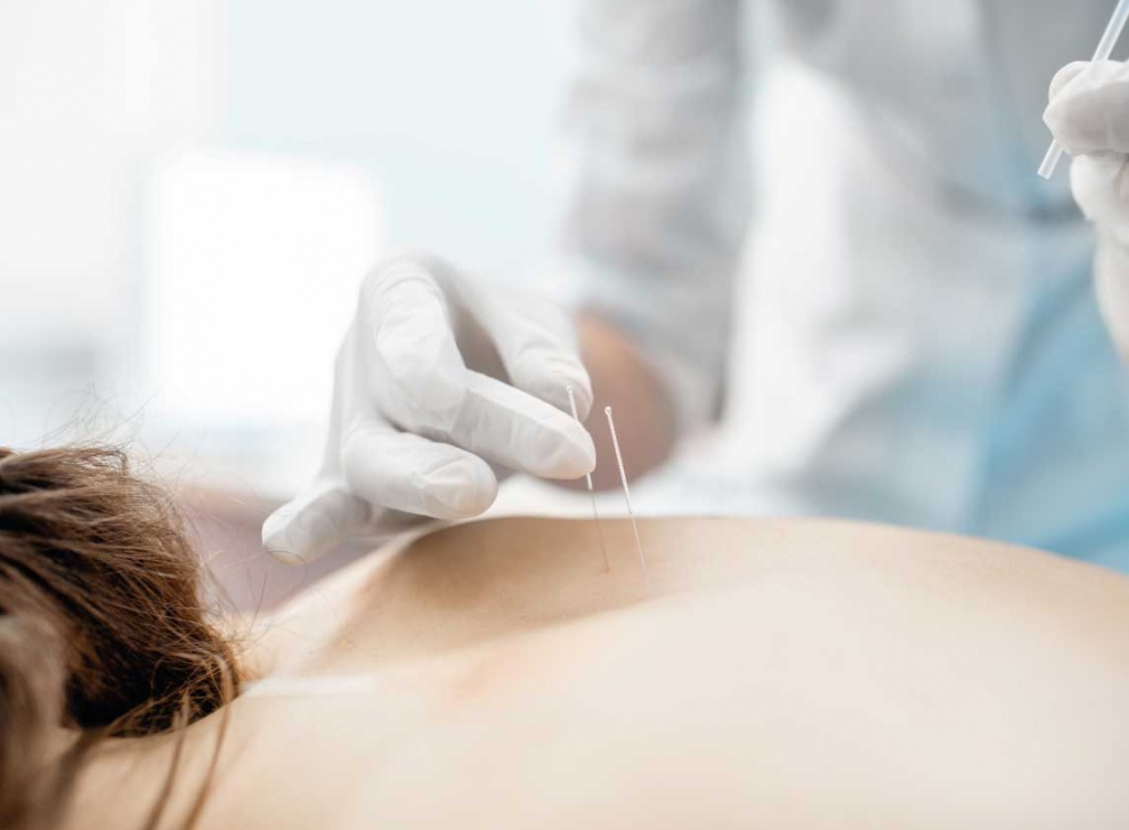 Лечение межпозвоночной грыжи иглоукалыванием