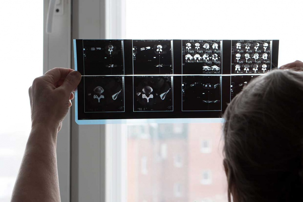 врач разглядывает коксартроз тазобедренного сустава на снимке