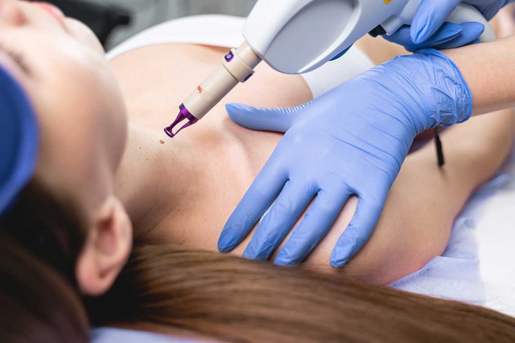 Пациентке проводят лазерное удаление невуса