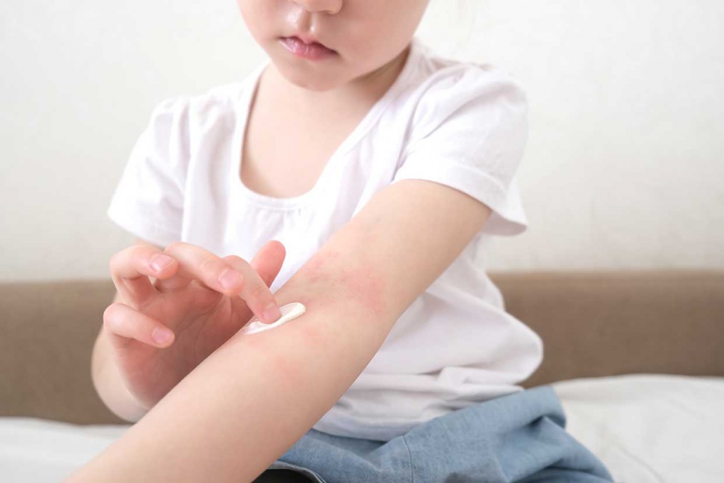 атопический дерматит