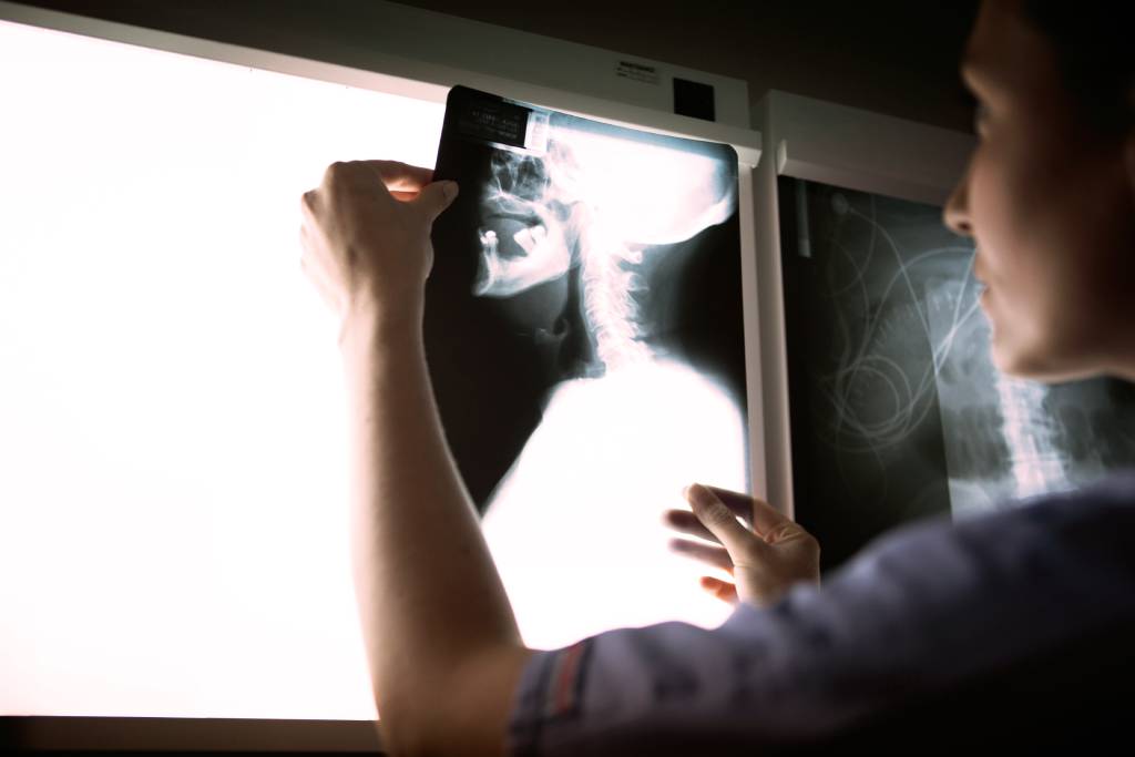 доктор рассматривает остеохондроз шейного отдела позвоночника на снимке