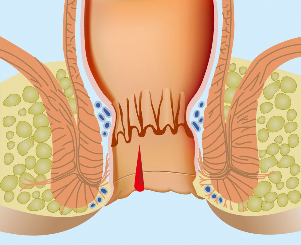 Анальная трещина у пациентов