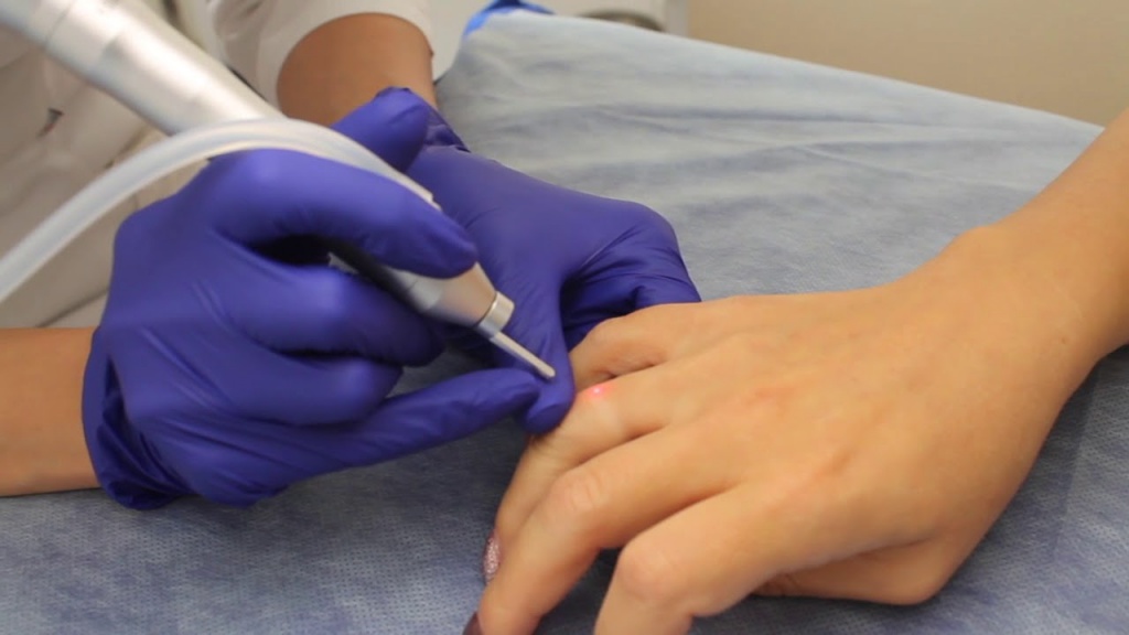 Удаление бородавок на лице и подошвенных бородавок лазером - цена в ...