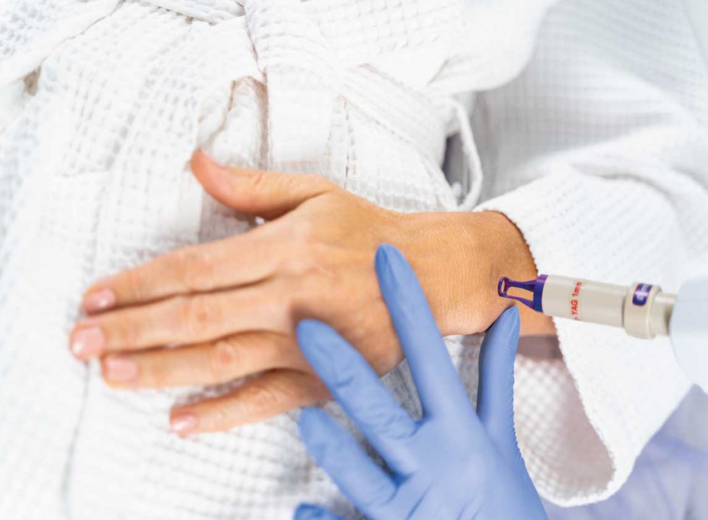 Удаление папиллом лазером на лице и веке - цена в Москве клиника ...